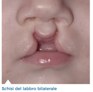 Labiopalatoschisi