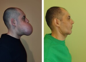 ameloblastoma Angelo Coga intervento