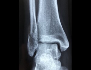 osteoporosi