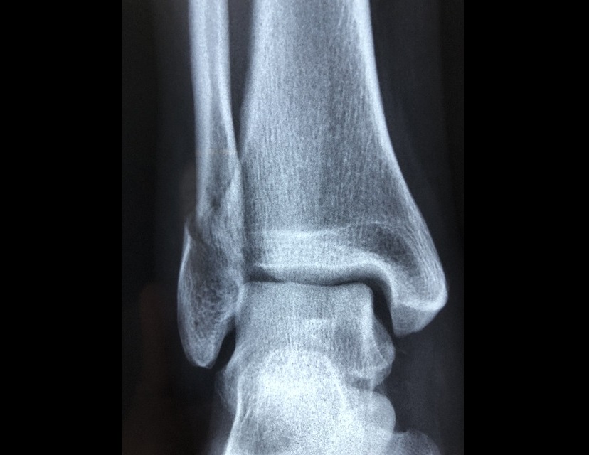 osteoporosi
