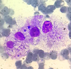 sindrome da attivazione macrofagica macrofagi aggrediscono cellule sane