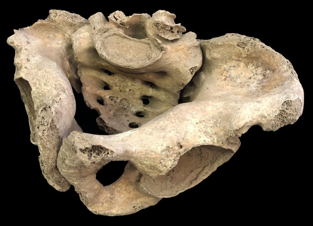 Immagine bacino osteomalacia studio unimi