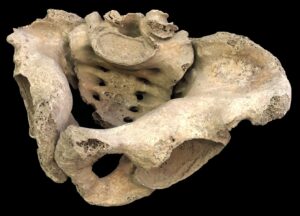 Immagine bacino osteomalacia studio unimi