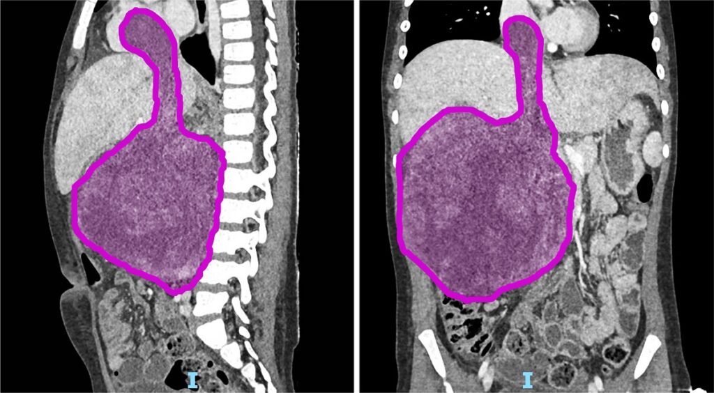 Nefroblastoma tumore rene bambino gesù