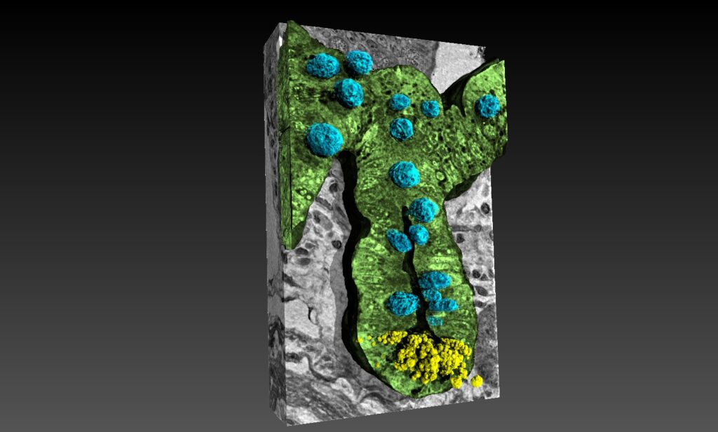 intestino cervello alzheimer