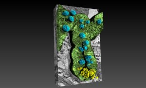 intestino cervello alzheimer