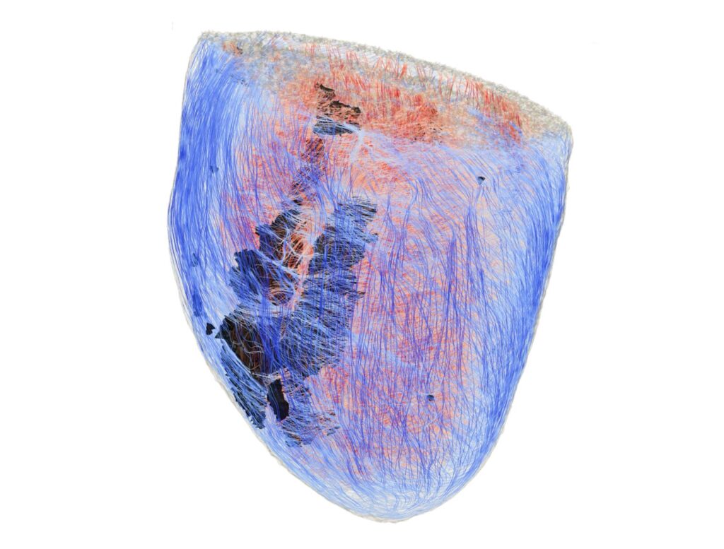 fibrosi cardiaca aritmie
