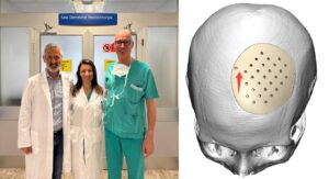 tumore cranio cto torino