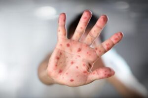 Morbillo
