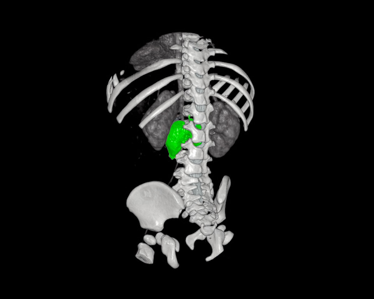 Neuroblastoma 3D