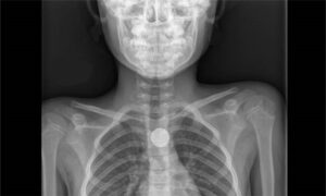 Radiografia BATTERIA A BOTTONE ingerita