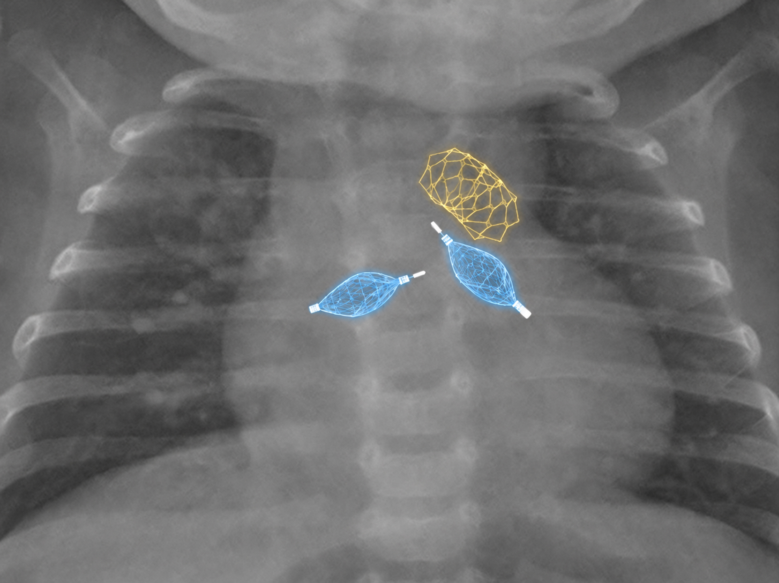 Radiografia intervento stent (giallo) e plug (blu)